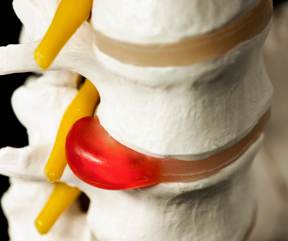 Hernia de disc: Prevenția recidivei cu KinetikMed Cluj